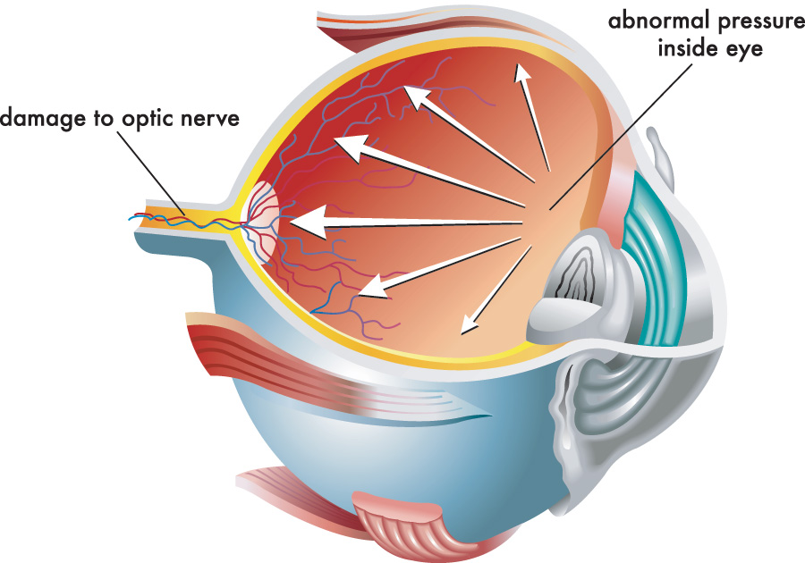 Graphic showing abnormal pressure inside of the eye causing damage to the optic nerve